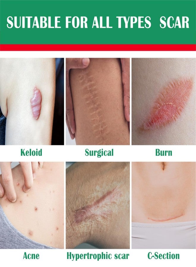 ليدي جو جل كريم السيليكون المتطور لعلاج الندبات: علاج الندبات القديمة والجديدة، إزالة علامات التمدد، علاج التئام الجلد بعد العمليات الجراحية، علاج الندبات الناتجة عن الولادة القيصرية، علاج الكيلويدات، علاج الجروح وحب الشباب، علاج البقع الداكنة للأطفال، 30 غرام (أخضر) - Image 3